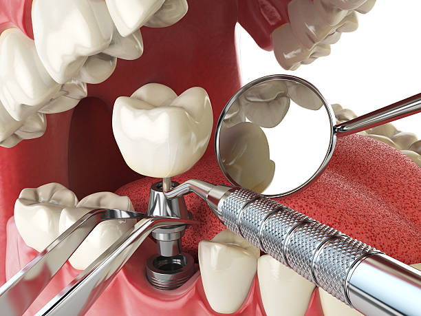 Best Weekend Emergency Dentist in Longbranch, WA