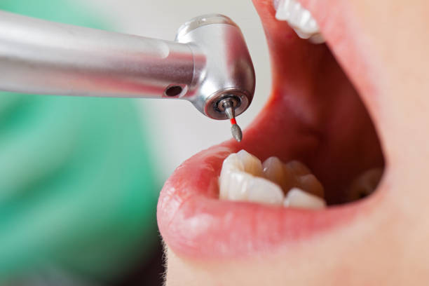 Best Emergency Tooth Extraction in Longbranch, WA
